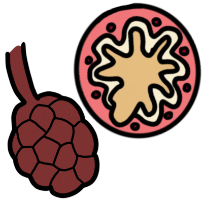 an emphysemic alveolus next to an inflamed bronchiole with mucus.