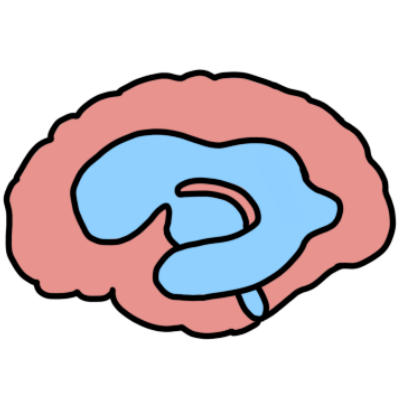 a simple drawing of a brain with enlarged ventricles.