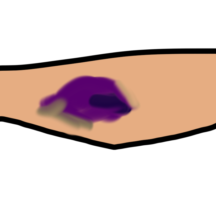 a light skinned arm with a purple, blue, and greenish bruise near the elbow.