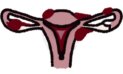 a simply drawn pink and white uterine system with red uterine lining and red splotches on other parts of it.